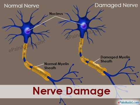 Exercises For Sciatic Nerve Damage